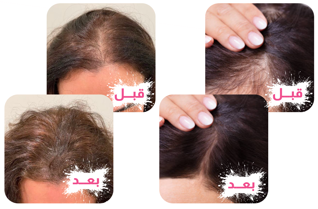 فرشاة علاج تساقط الشعر