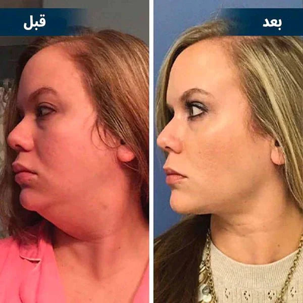 جهاز التجميل ومنع الشخير المعجزة اثناء النوم - Makfool
