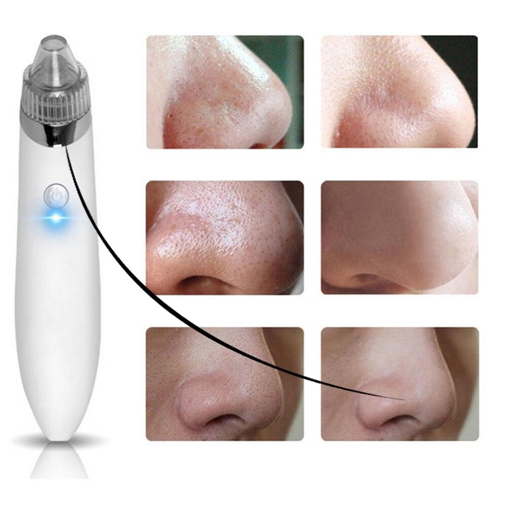 جهاز ازالة الرؤوس السوداء - Makfool